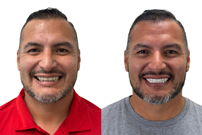 aldo before and after dental implant