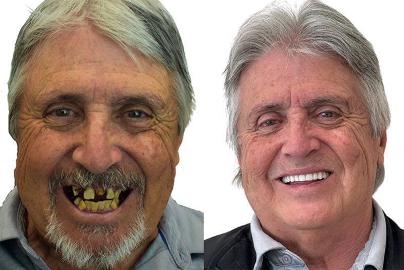 claude before and after dental implant