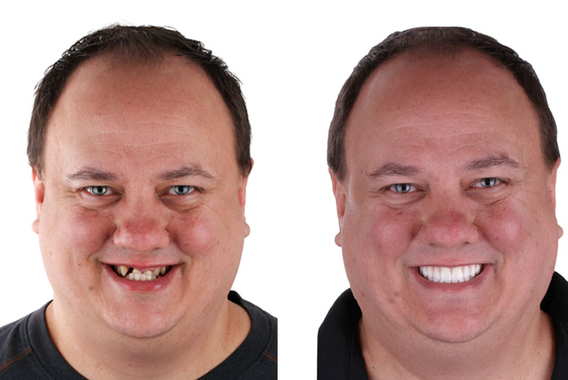 colin before and after dental implant