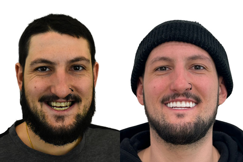 evan before and after dental implant