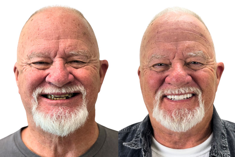 robin before and after dental implant