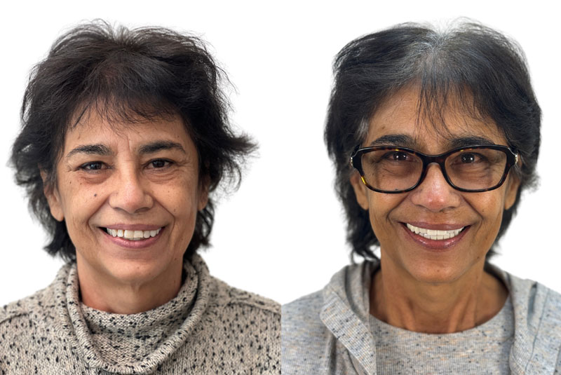 susie before after dental implant