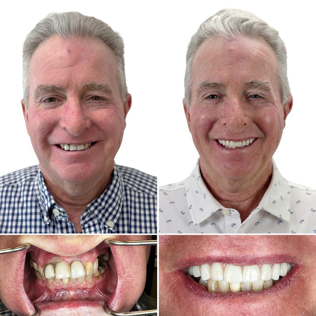 REVA Dental Implant Case Cluster Alex